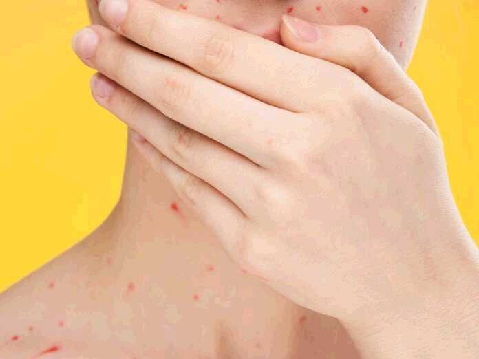 chickenpox inside your mouth