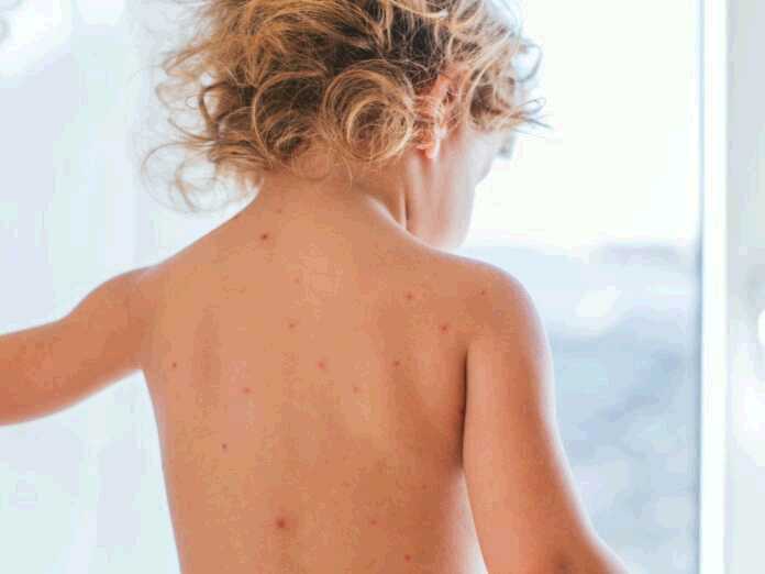 connection between chickenpox and shingles