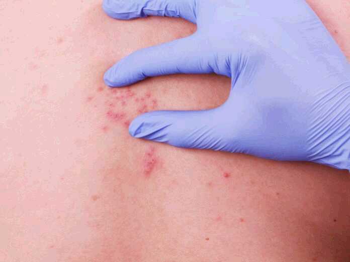 symptoms of an undiagnosed shingles infection
