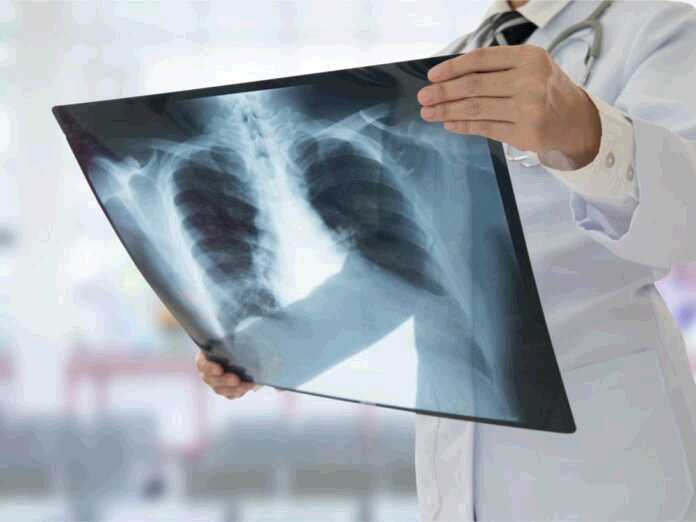 what is the black lung disease