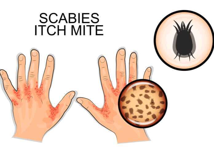 symptoms of scabies
