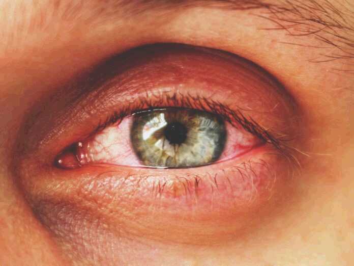 types of pink eye