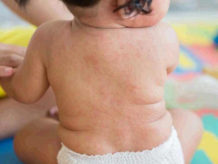 causes, symptoms, and treatment for roseola