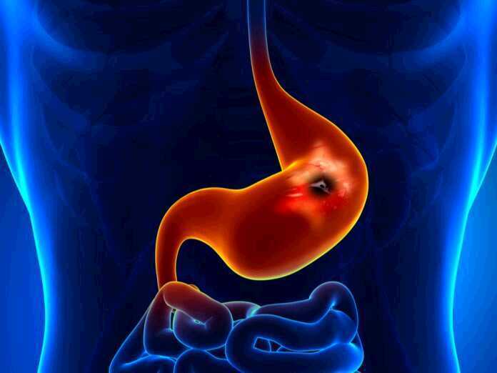 causes of stomach ulcers